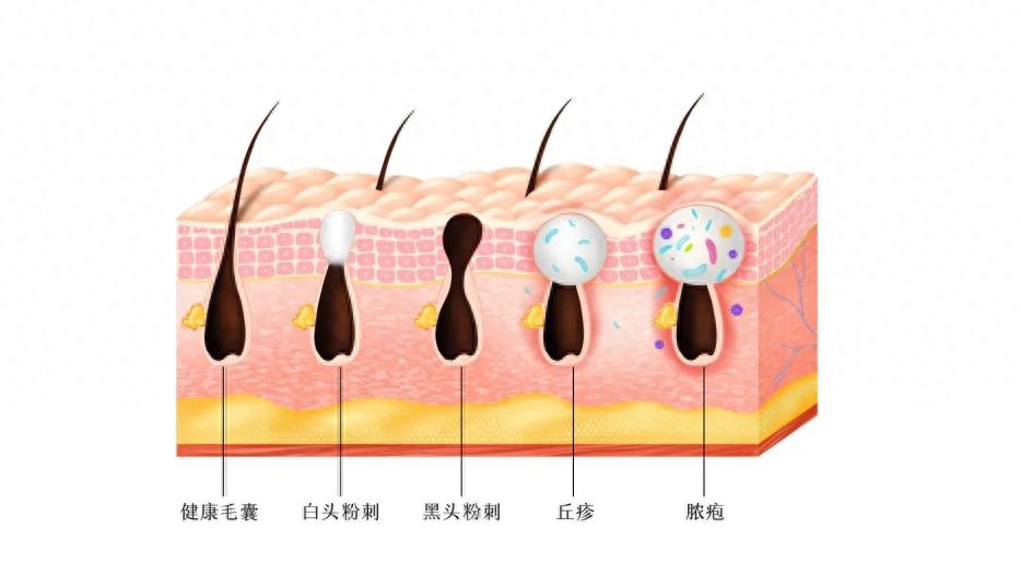 什么是脂肪粒，如何改善脂肪粒