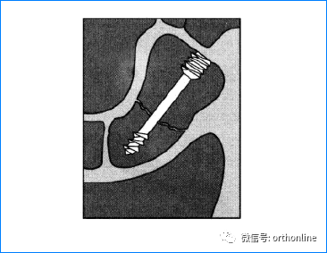 常用的内固定螺钉有哪些，螺钉固定技术