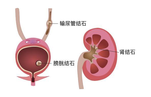 经常憋尿会带来很多危害，甚至危及生命