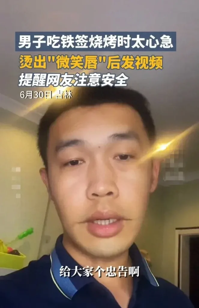 男子吃烧烤被烫出微笑唇，吃烧烤嘴边让签字烫了一下留疤吗