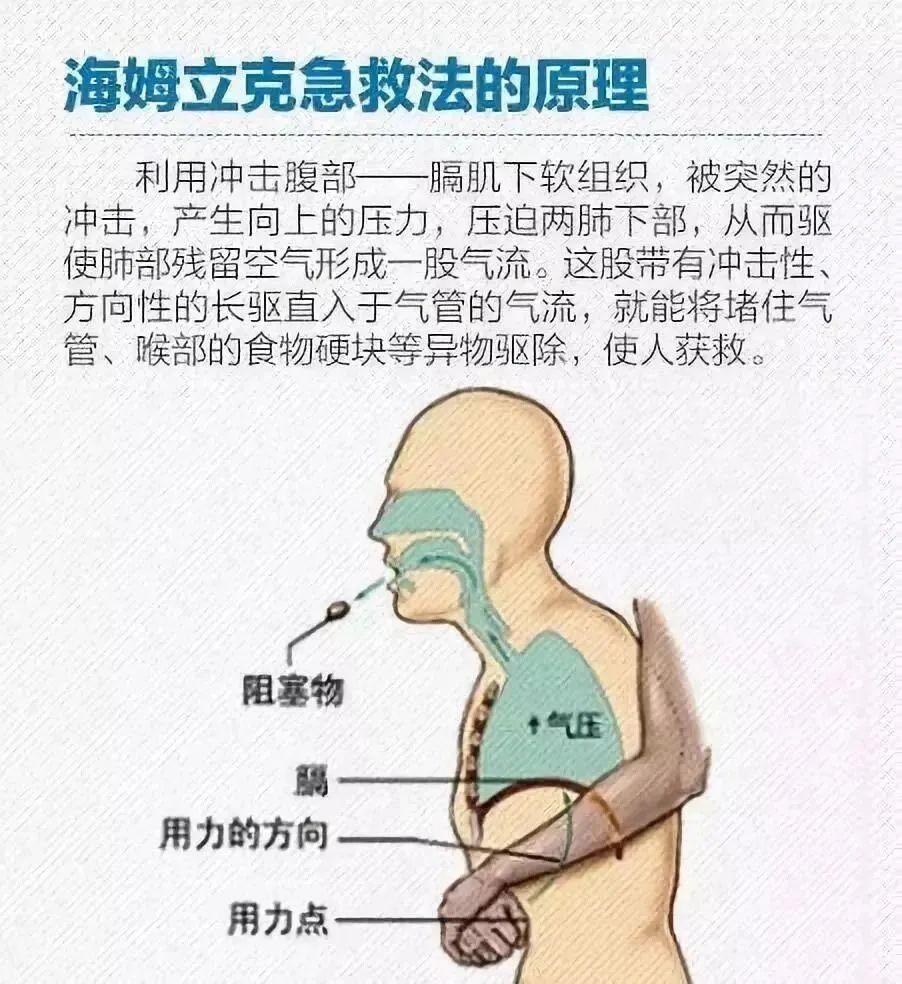 海姆立克急救法(多图示意,收藏转发)