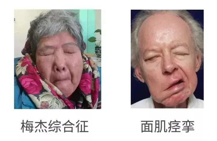 “快乐精灵”的病因为何?梅杰综合征与面肌痉挛有什么不同?